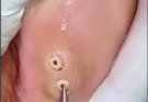Big Cystic Acne Blackheads Extraction Blackheads & Milia, Whiteheads Removal Pimple Popping